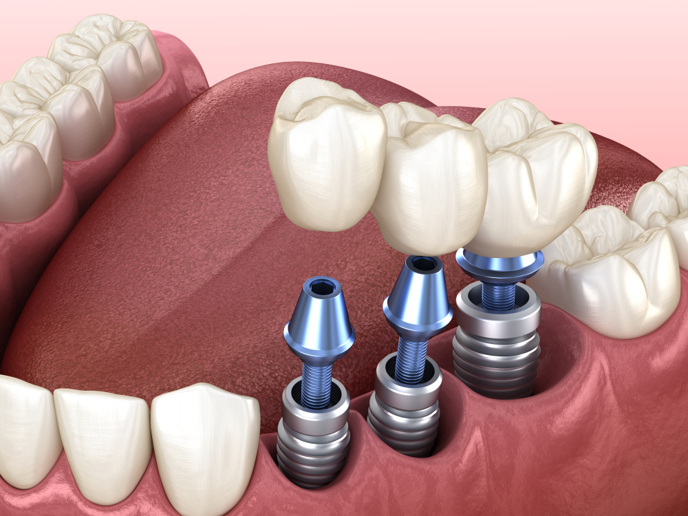 dental implants Crittenden, KY