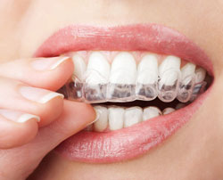 hand holding clear teeth aligners in mouth, Invisalign Crittenden, KY